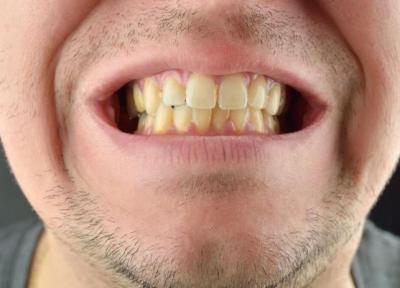 این عادت های غلط دندان های شما را زرد می کند